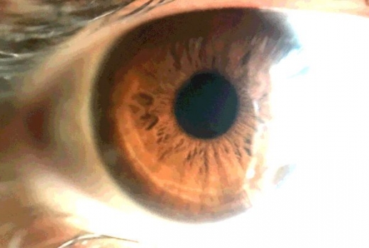 posterized eye image